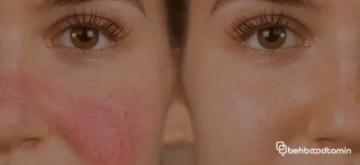 علل ایجاد اگزما