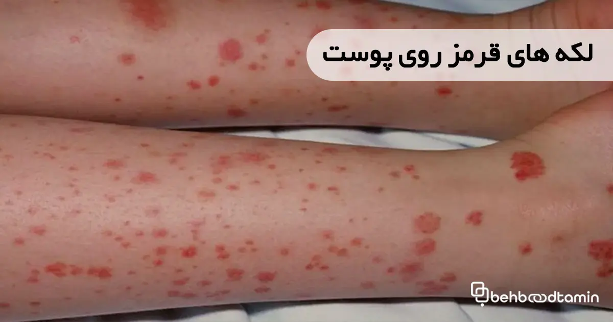لکه های قرمز روی پوست
