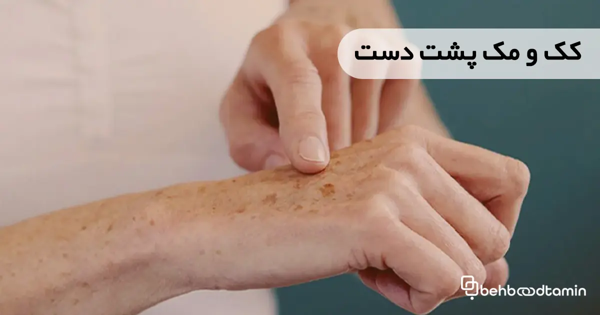 کک و مک پشت دست