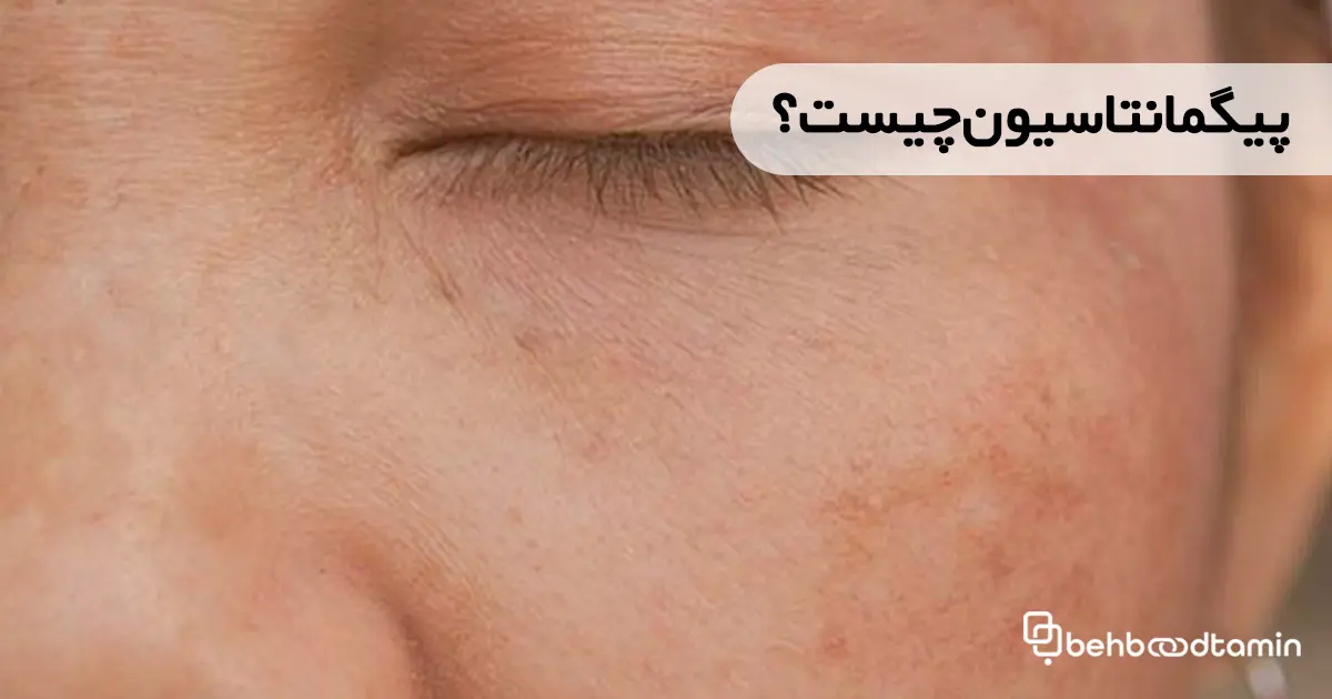 پیگمانتاسیون چیست؟