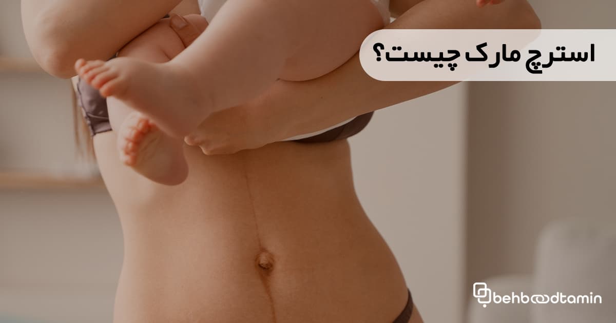 استرچ مارک چیست؟