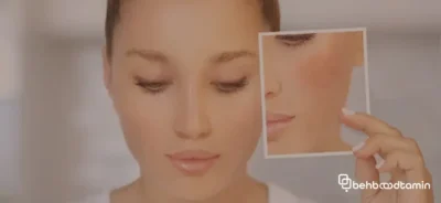 علل پیگمانتاسیون