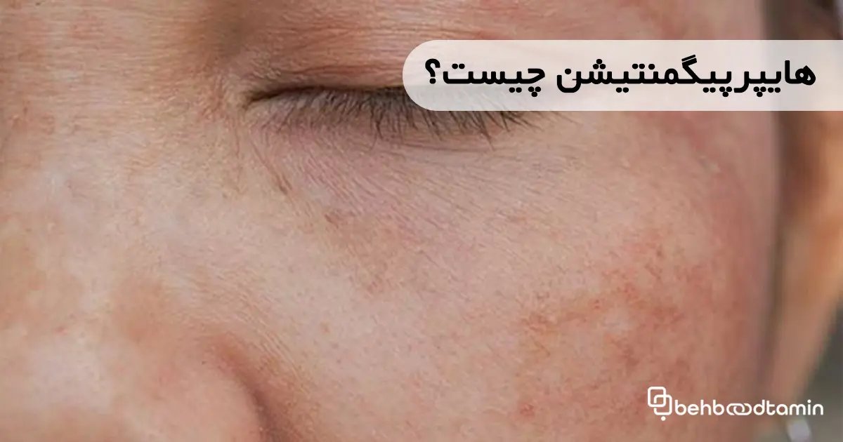 هایپرپیگمنتیشن چیست؟
