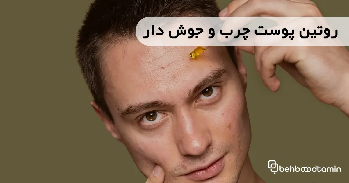 روتین پوست چرب جوش دار