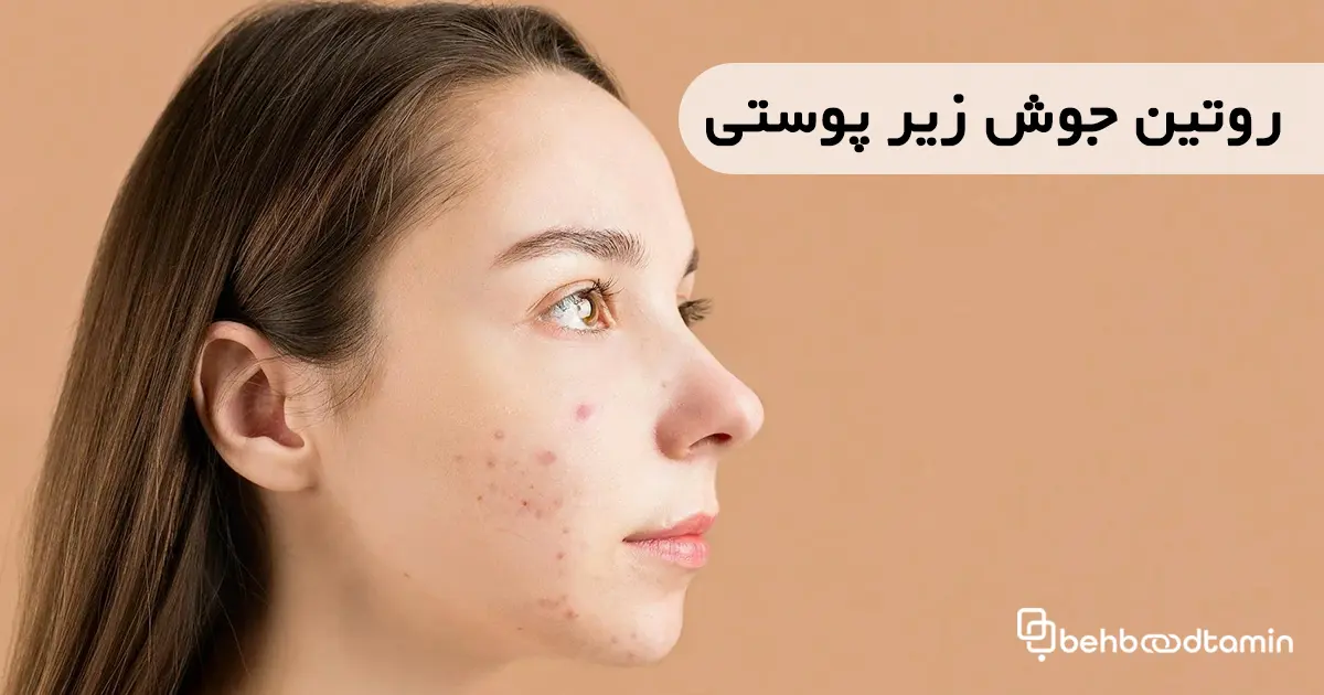 روتین جوش زیر پوستی
