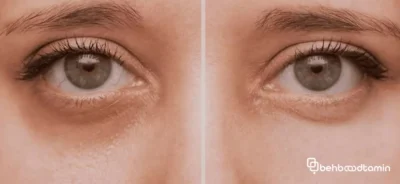 روش های رفع تیرگی دور چشم