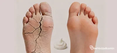روش های برطرف کردن ترک های پا
