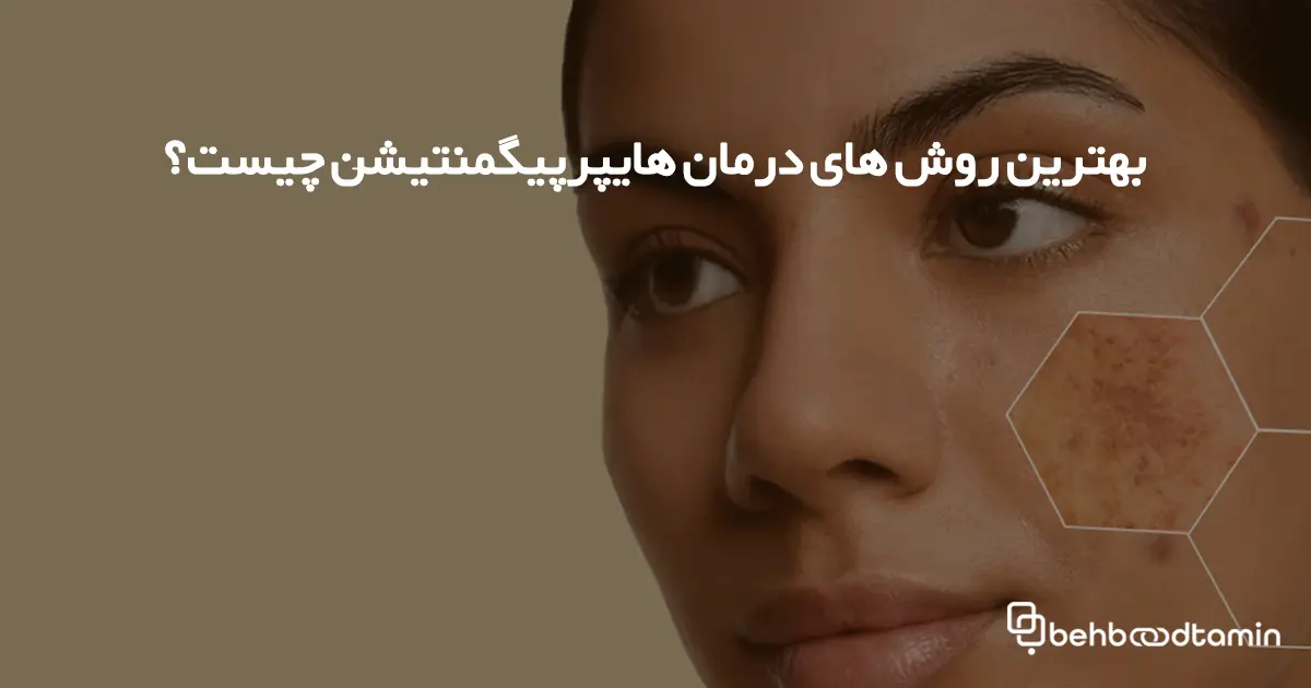 بهترین روش های درمان هایپرپیگمنتیشن چیست؟  