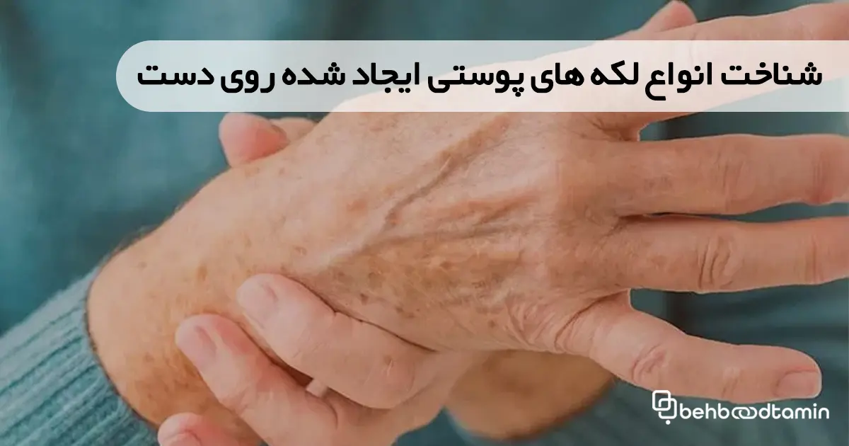 شناخت انواع لکه های پوستی ایجاد شده روی دست