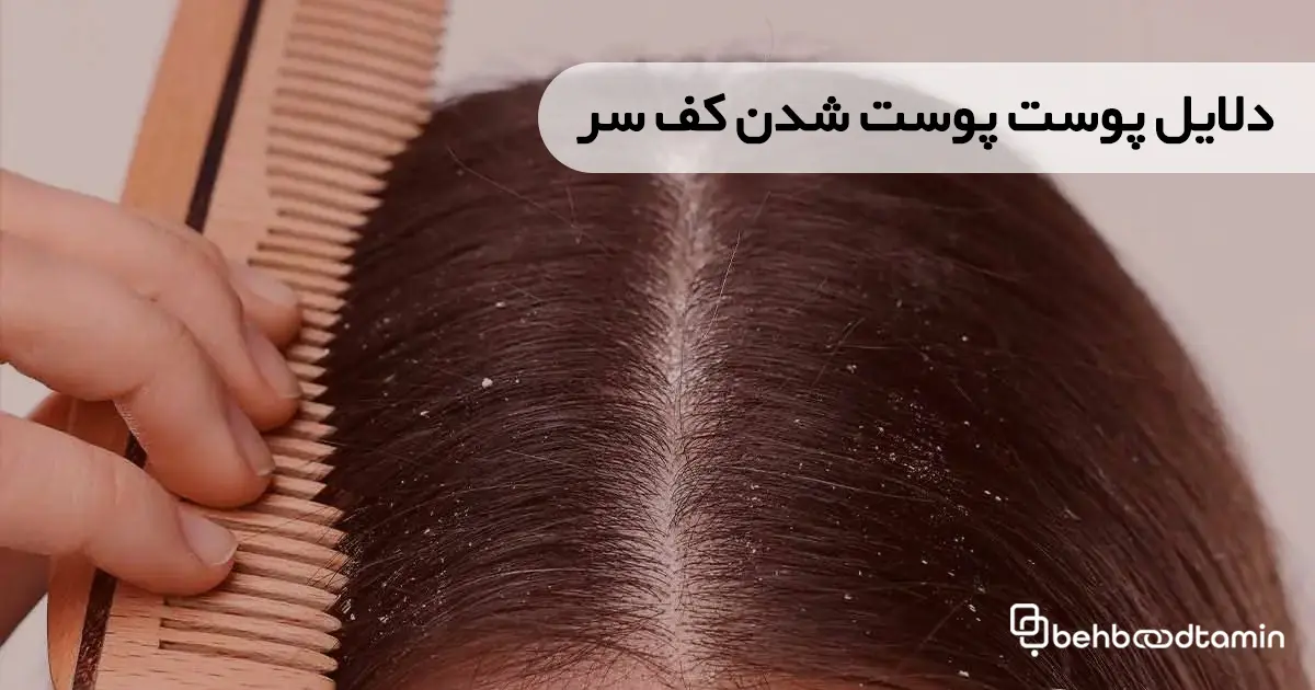دلایل پوست پوست شدن کف سر