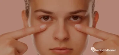 راهکارهای از بین بردن پف زیر چشم