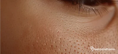 راهکارهای خانگی برای متعادل‌سازی چربی پوست