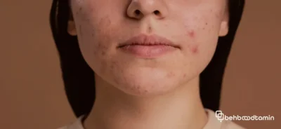 ویژگی بهترین سرم ضد جوش برای پاکسازی صورت