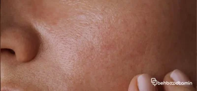 دلایل چرب شدن پوست صورت