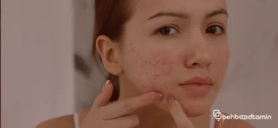 نکات طلایی برای موفقیت در درمان جوش