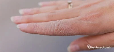 علت های خشکی پوست کل بدن