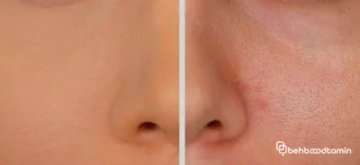 ضدآفتاب مناسب پوست چرب و منافذ باز چه ویژگی‌هایی دارد؟