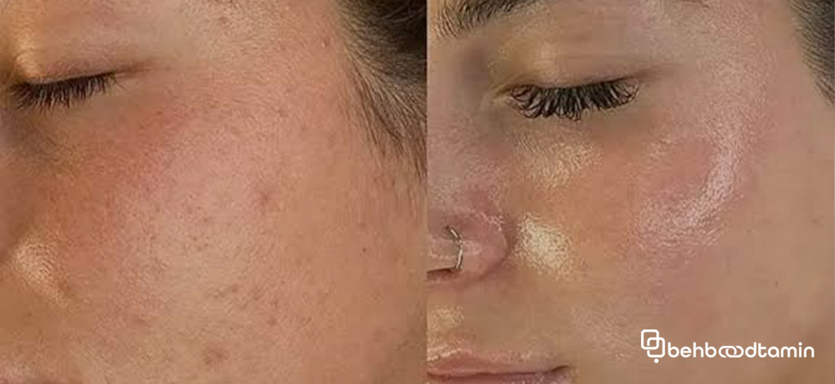 مراقبت‌های ضروری برای جلوگیری از لک بعد از میکرونیدلینگ